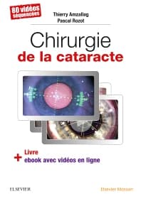 Chirurgie de la cataracte