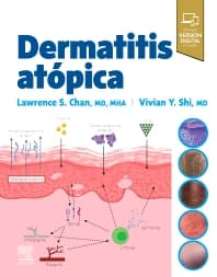 Dermatitis atópica