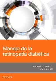 Manejo de la retinopatía diabética